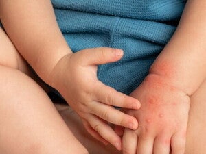 Cara Tes Alergi Susu Sapi Pada Bayi Cara Tes Alergi Susu Sapi Pada Bayi
