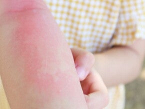 Perbedaan Campak dan Alergi pada Anak  Perbedaan Campak dan Alergi pada Anak