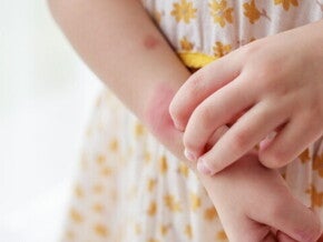 Alergi Makanan pada si Kecil: Gejala, Penyebab, dan Cara Mengatasinya   Alergi Makanan pada si Kecil: Gejala, Penyebab, dan Cara Mengatasinya