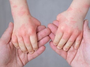 Ciri-ciri Alergi Susu Sapi pada si Kecil dan Cara Pencegahannya   Ciri-ciri Alergi Susu Sapi pada si Kecil dan Cara Pencegahannya