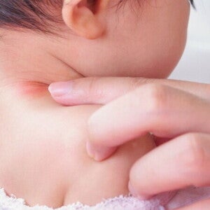 Tips dan Trik Mengatasi Ruam Kulit Alergi Pada Si Kecil Tips dan Trik Mengatasi Ruam Kulit Alergi Pada Si Kecil